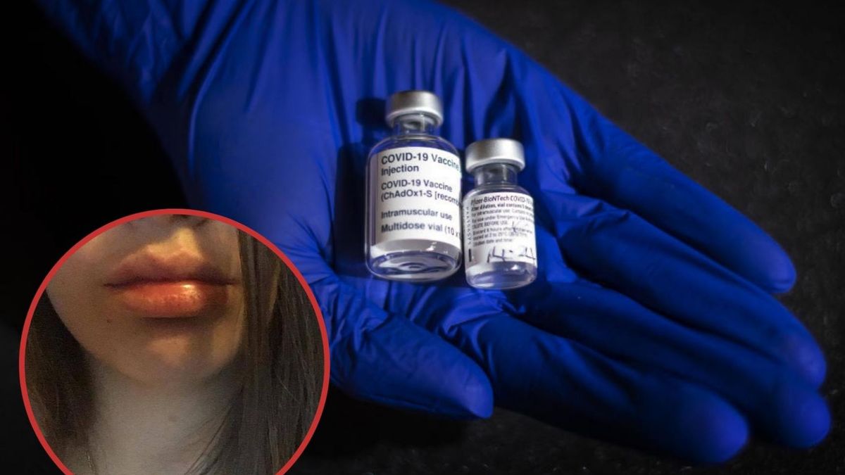 Obrzęki po szczepieniu przeciwko COVID. Najbardziej narażone osoby, które stosowały wcześniej kwas hialuronowy