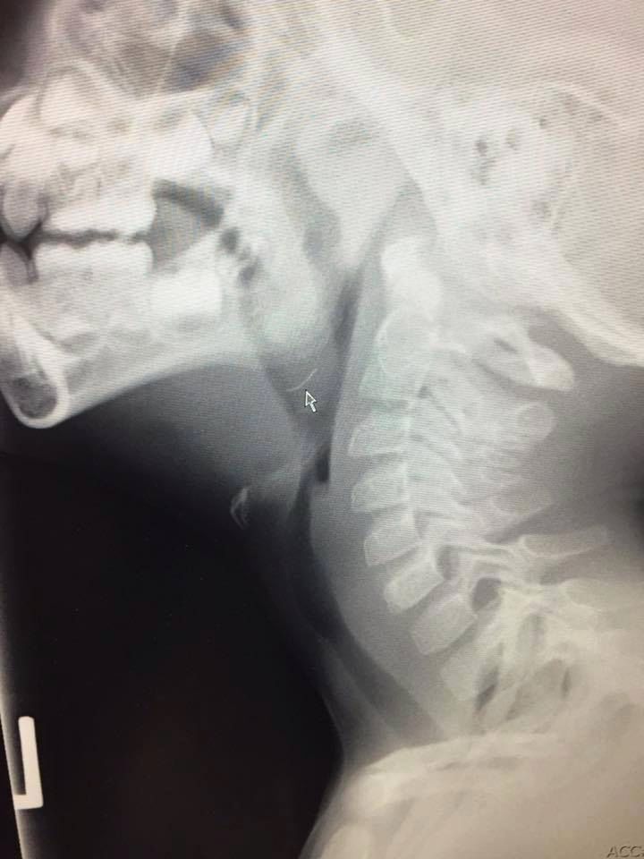 Mały Ollie zaczął się krztusić po zjedzeniu mięsa z grilla