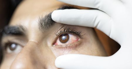 Zamknięto tysiące szkół. W Azji walczą z epidemią "różowego oka"