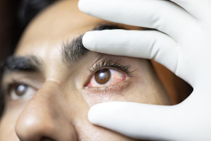 Nawet 13 tys. przypadków w jeden dzień. Azja walczy z epidemią "różowego oka"