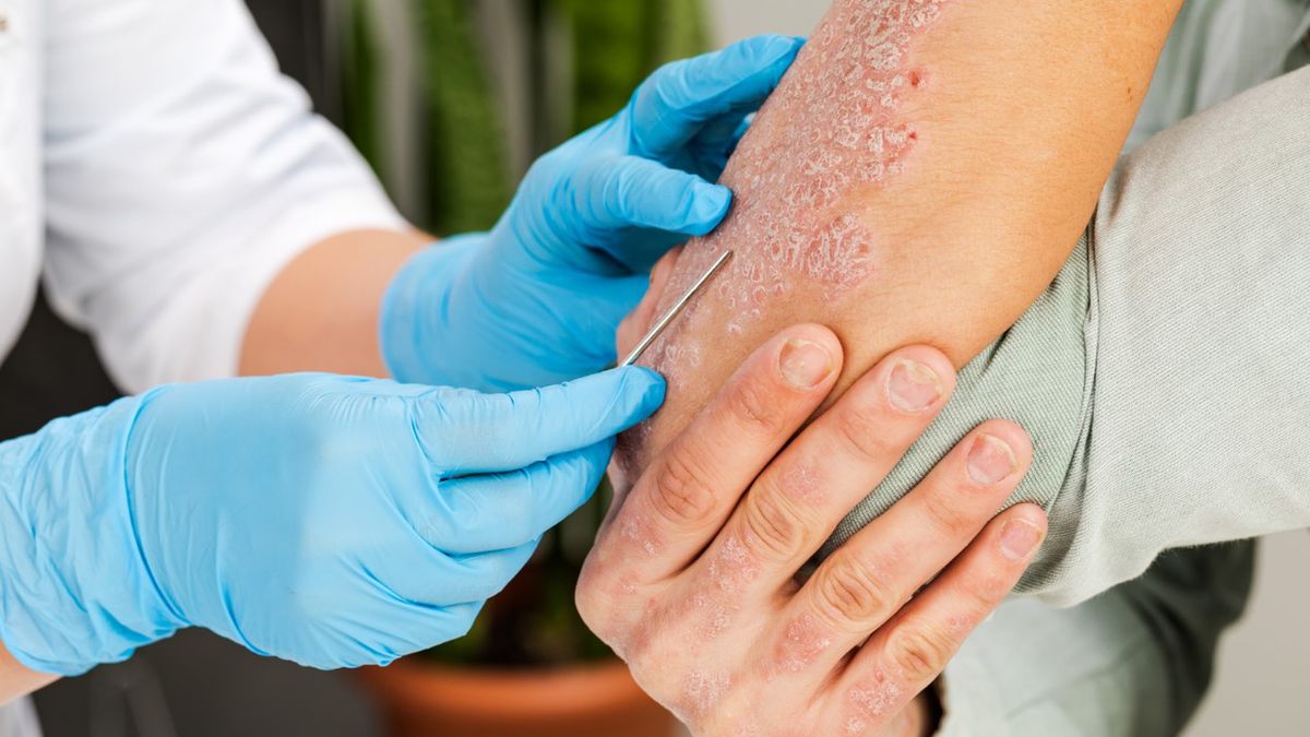 Łuszczyca jest najczęściej rozpoznawaną chorobą dermatologiczną.