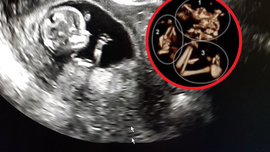 Lekarz wyjaśnia czym jest "syndrom znikającego bliźniaka". Wiele kobiet nie wie, że było w ciąży bliźniaczej