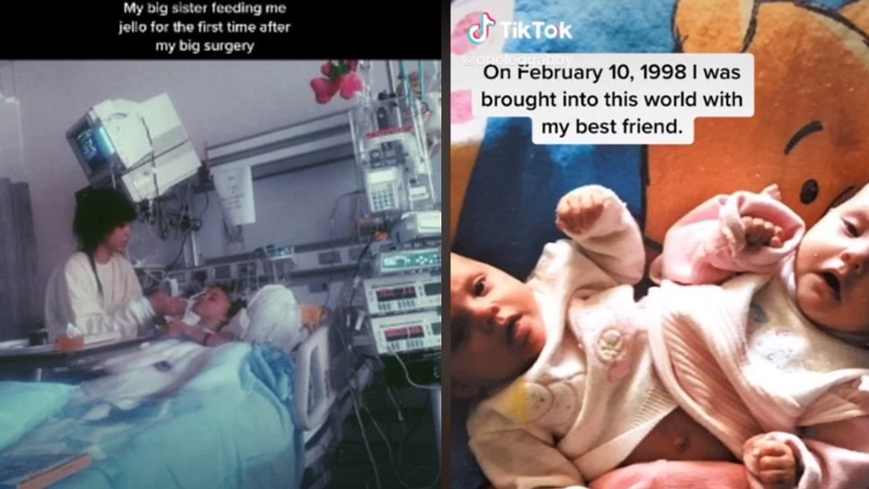 Jedna z bliźniaczek syjamskich zmarła kilka lat po operacji. Jej siostra dzieli się ich historią na TikToku