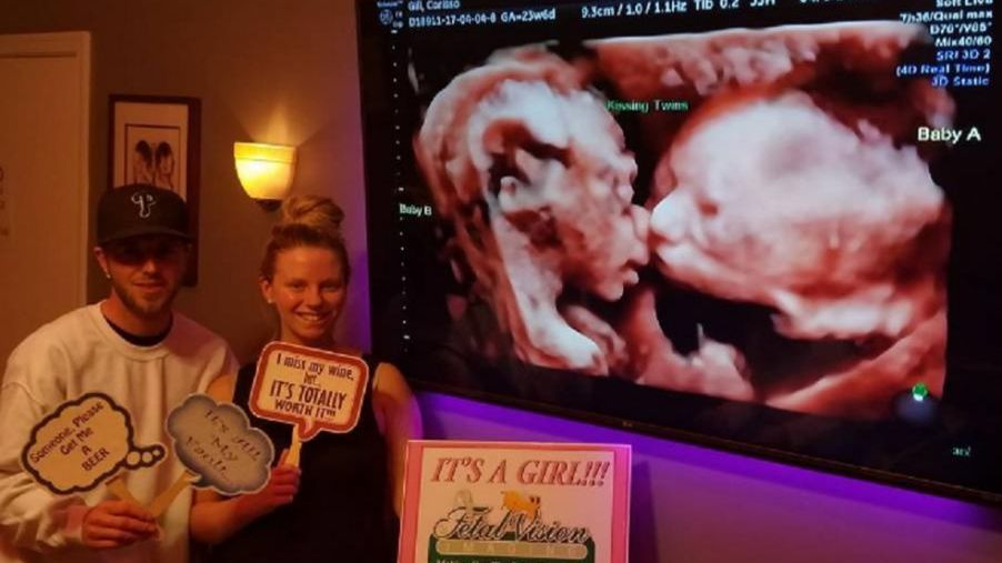 USG 3D bliźniaczek, które dają sobie całusa