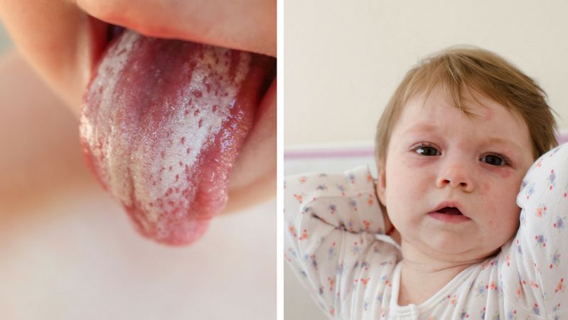 Ból gardła u dziecka