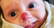 Urodziła się z nietypowym znamieniem. Półtoraroczna dziewczynka ma nos klauna