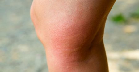Rumień alergiczny – przyczyny, objawy, sposoby leczenia