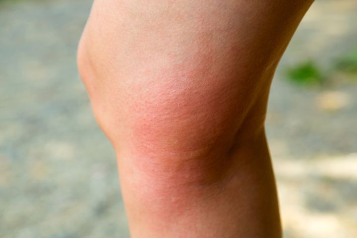 Rumień alergiczny może objawiać się czerwonymi plamami i swędzeniem