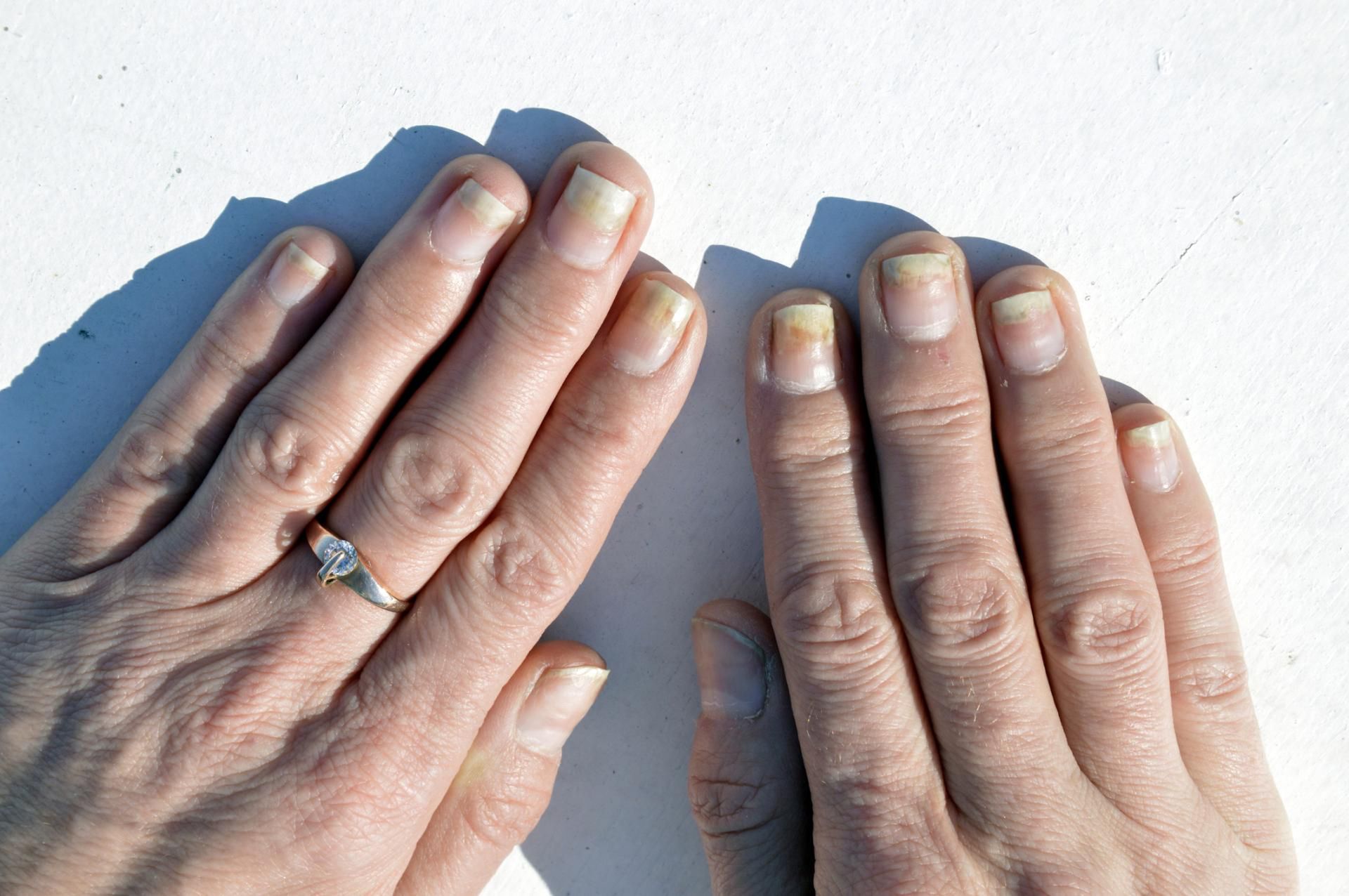 Żółtawe plamy to jeden z objawów łuszczycy paznokci