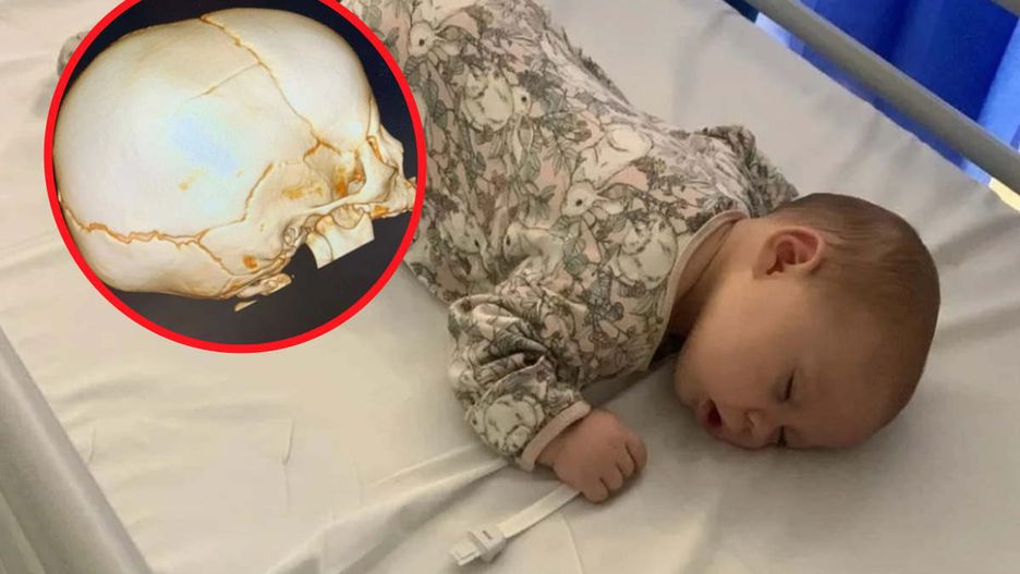 Lekarze zdiagnozowali u dziewczynki złamanie kości czaszki