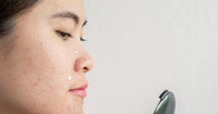 Acne-Derm – skład, wskazania, stosowanie, skutki uboczne