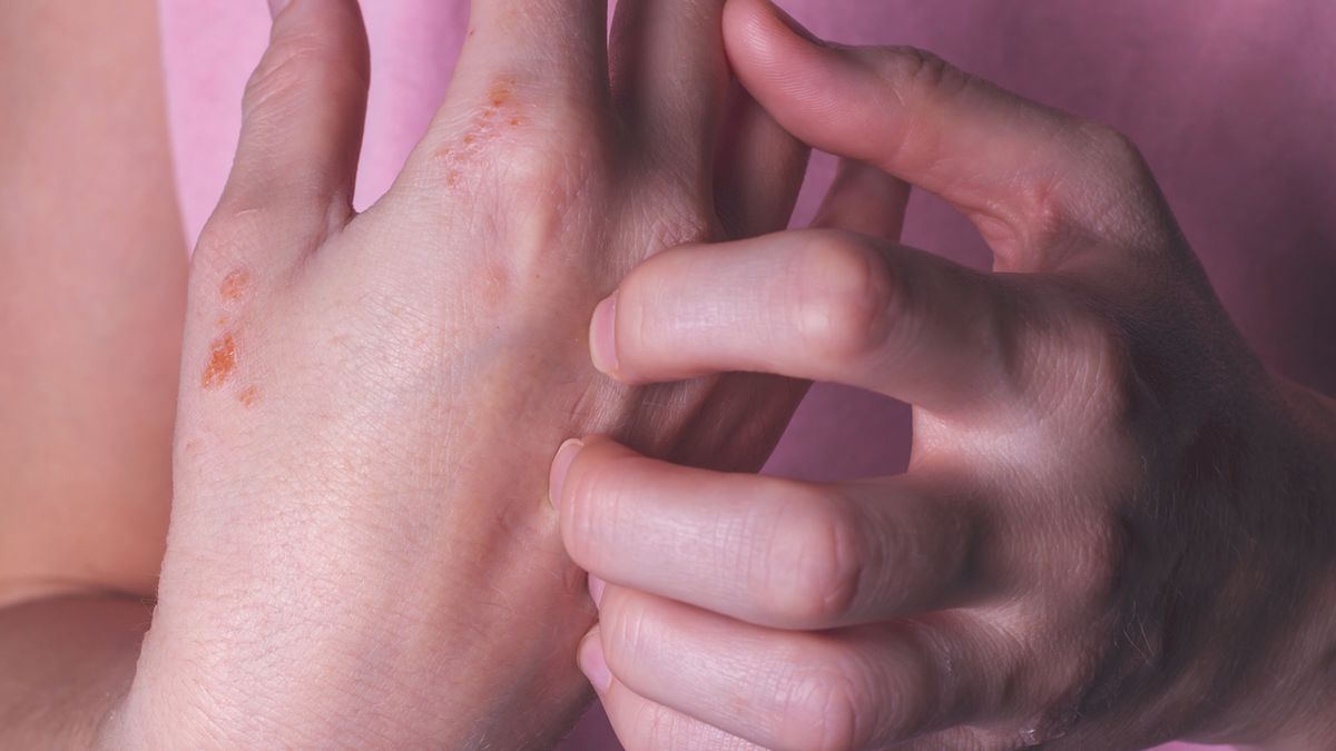 Alergia pokarmowa może powodować bardzo silne i niebezpieczne objawy