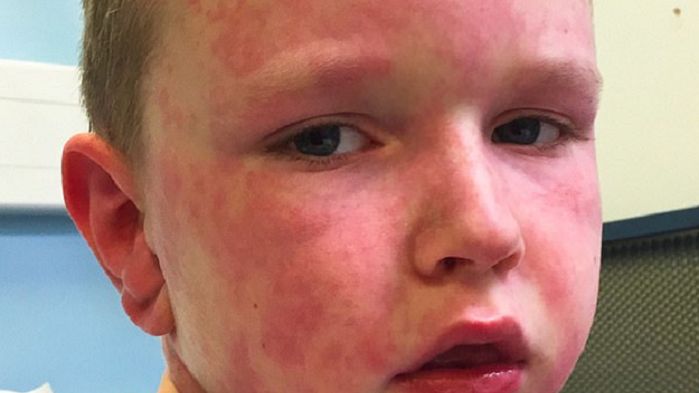 Tak wygląda uczulenie na zimę. To rzadki rodzaj alergii   