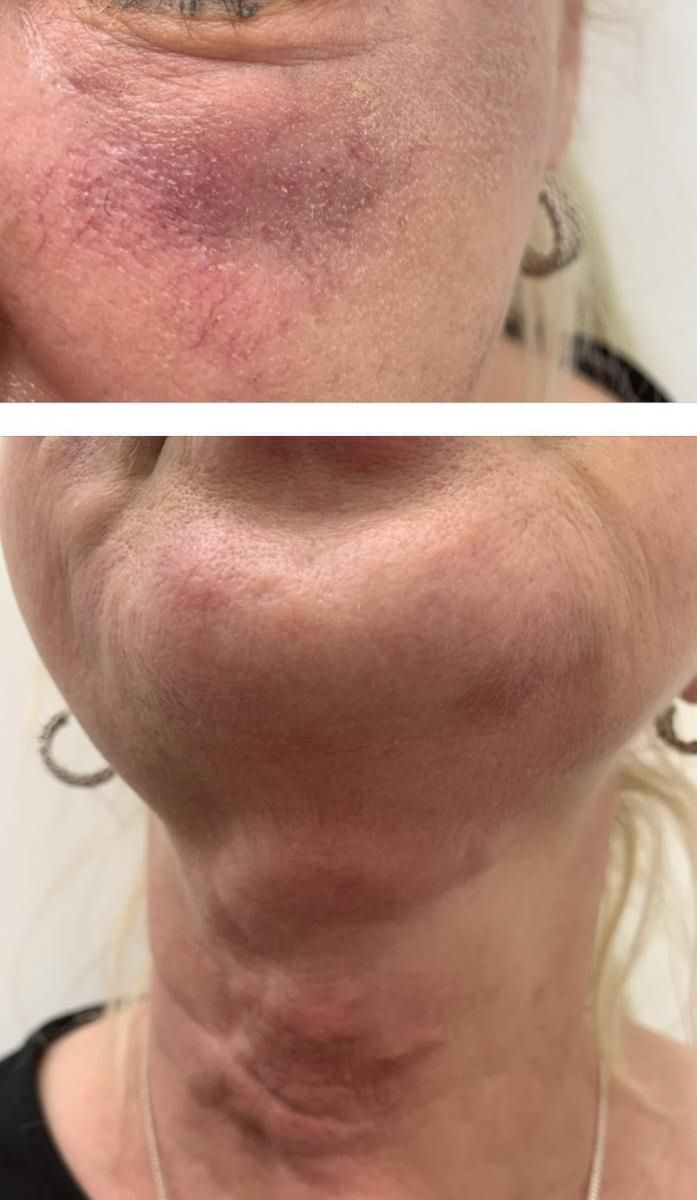 Powikłania po wstrzyknięciu kwasu hialuronowego niewiadomego pochodzenia