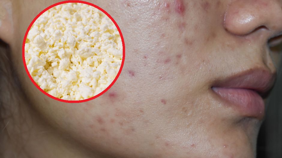 Masz trądzik? Unikaj tych produktów, które mogą pogorszyć stan twojej skóry