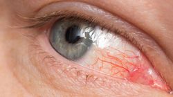 Jakie są najczęstsze przyczyny zapalenia rogówki?