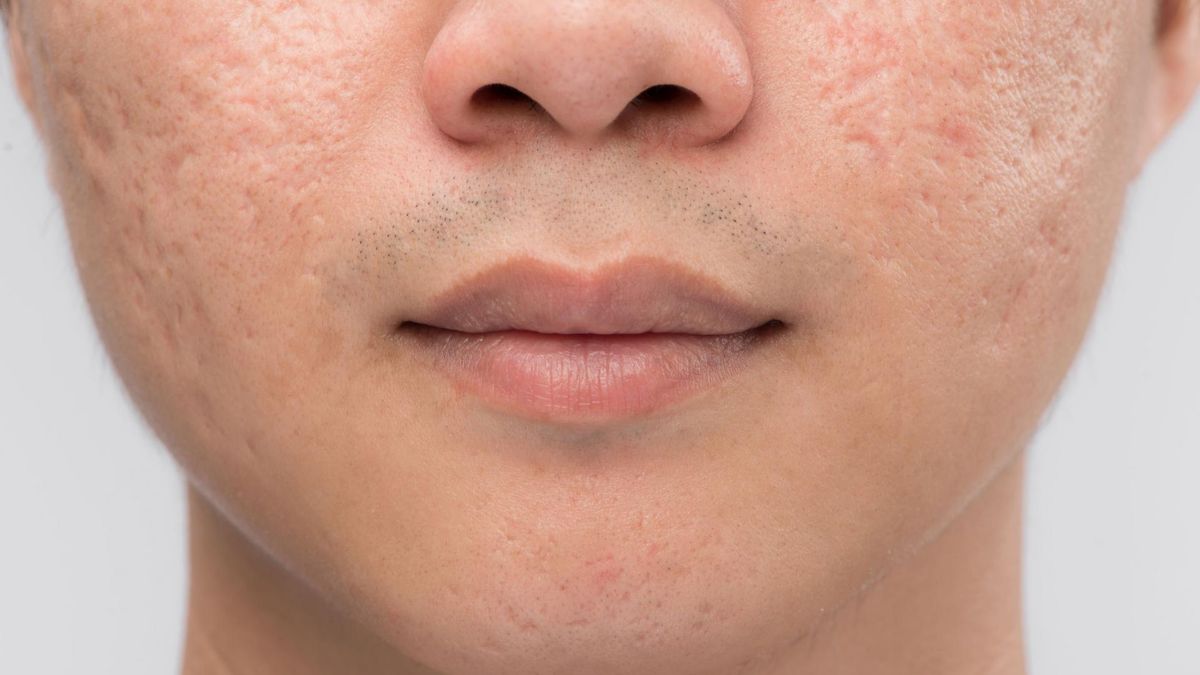 Izotretynoina (kwas 13-cis-retinowy) jest pochodną witaminy A