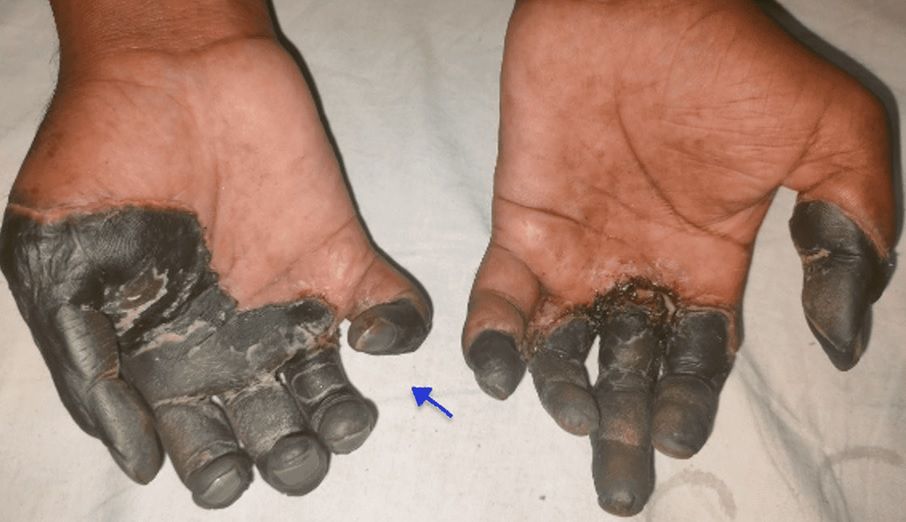 Mężczyzna trafił do szpitala z powodu zasinienia dłoni