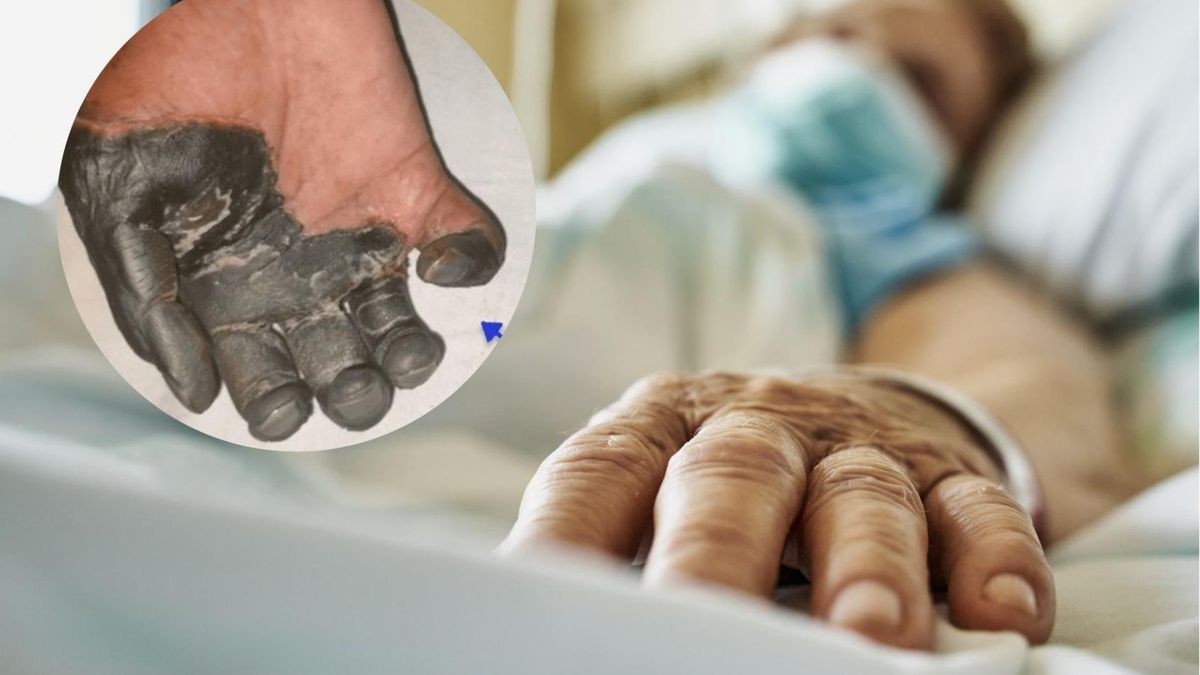 Zaczęło się odbólu i mrowienia rąk. Takie mogą być pierwsze objawy choroby Buergera, która najcześciej atakuje palaczy