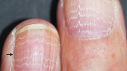 Charakterystyczne zmiany na paznokciach. Świadczą o raku żołądka