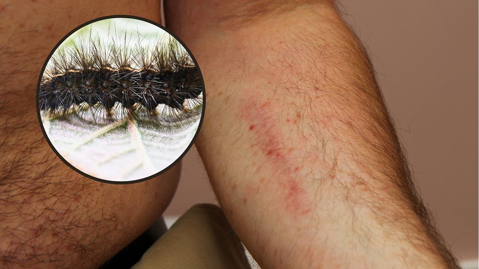 W jego ciele utknęły włoski gąsienicy. To doprowadziło do podrażnienia skóry