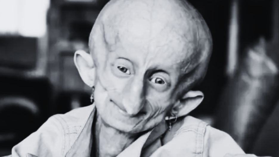 Beandri Booysen od wczesnego dzieciństwa zmagała się z progerią, chorobą genetyczną powodującą przyspieszone starzenie się organizmu