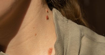 Nie tylko czerniak. Dwa groźne raki skóry atakują znacznie częściej