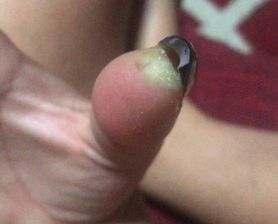 Kobiecie amputowano kciuk po tym, jak przedłużała sobie paznokcie w salonie kosmetycznym