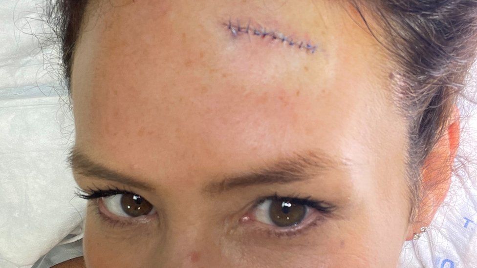 Dziś po znamieniu pozostała niewielka blizna