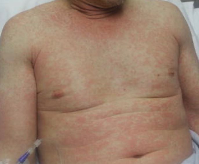 Zmiany plamisto-grudkowe przy COVID-19