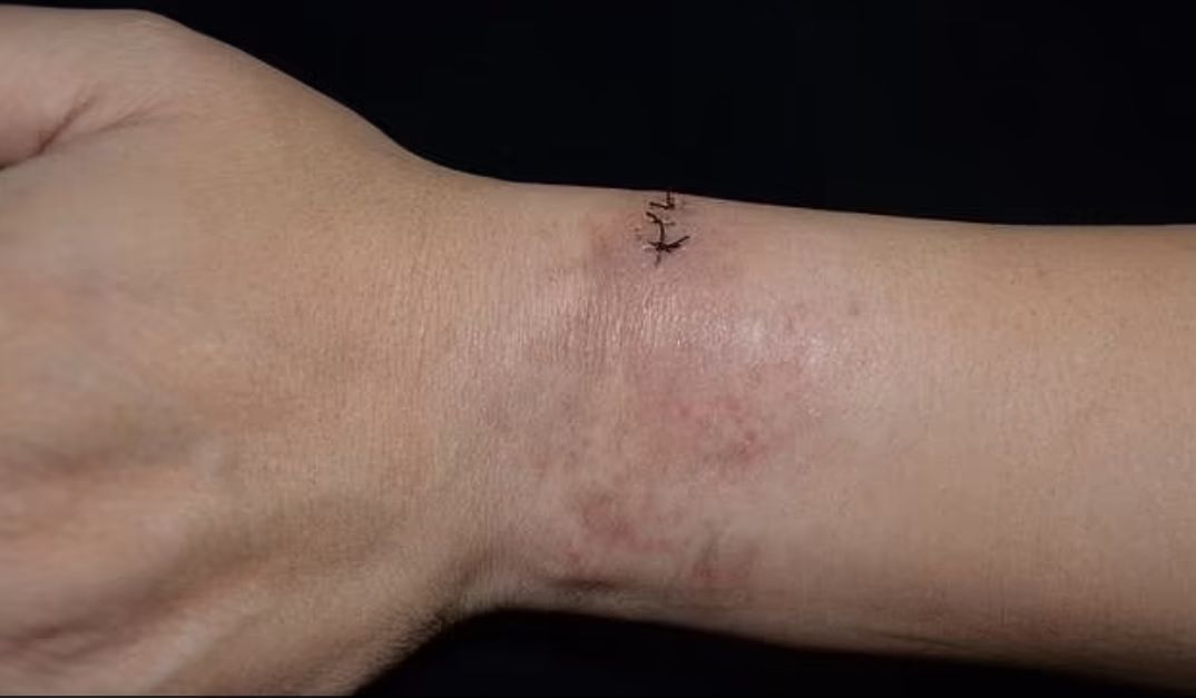 Miał wysypkę w okolicach nadgarstka. Okazało się, że w jego ręce utkwiły włoski gąsienicy