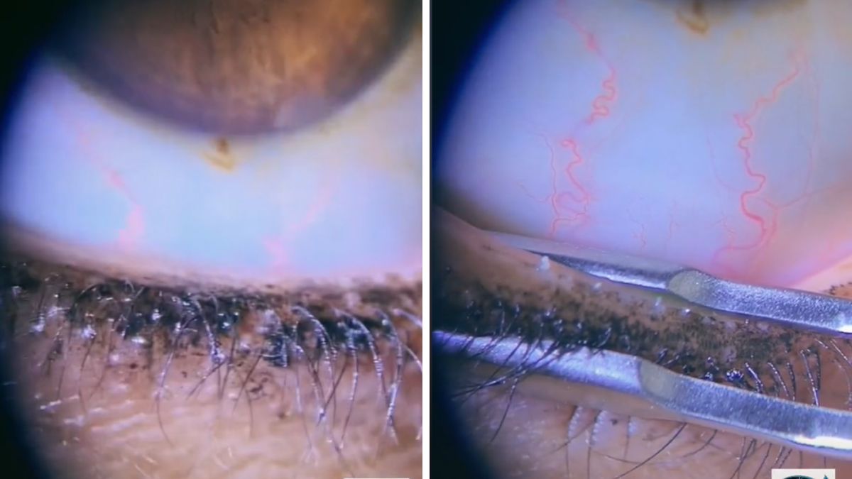 Lekarka ostrzega przed eyelinerem. Może prowadzić do zatkania gruczołów i skutkować poważnymi problemami