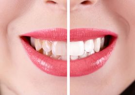Naturalne metody wybielania zębów (WIDEO)
