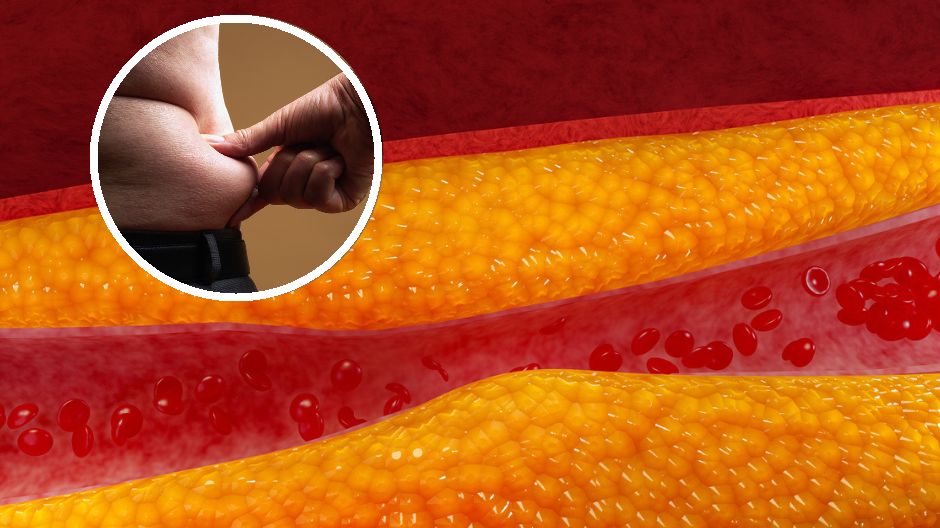 Jakie objawy daje wysoki cholesterol?