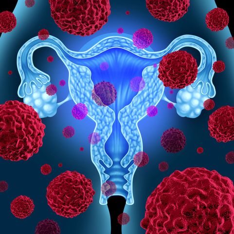 Rak trzonu macicy daje o sobie znać poprzez nieprawidłowości w okolicach intymnych (123rf.com)