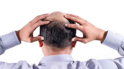Skuteczny sposób na łysienie. Nowe badania