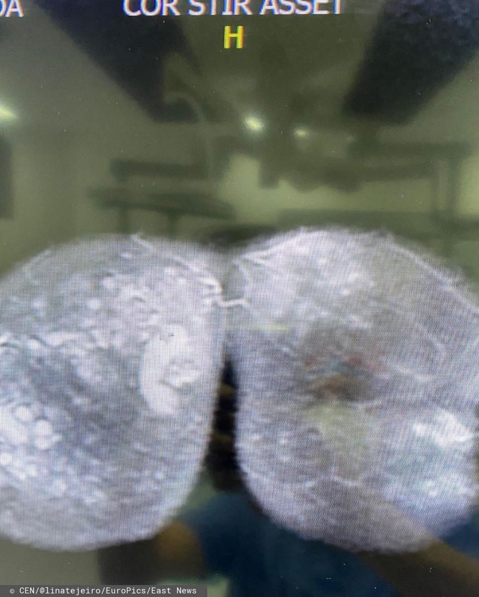 Aktorka musiała przejść operację, żeby usunąć szkody po zastrzykach silikonu