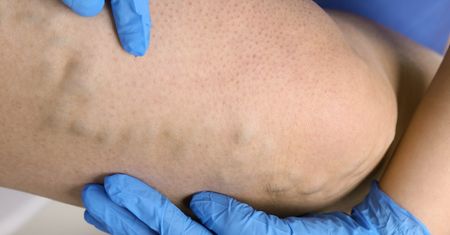 Skleroterapia – wskazania do zabiegu, efekty i przeciwwskazania
