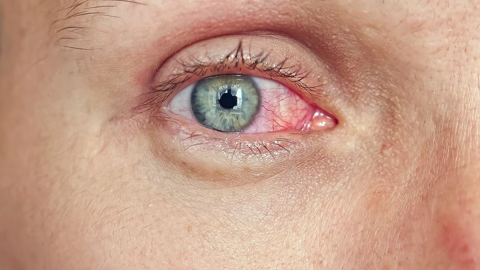 Jakie objawy daje gruźlica?