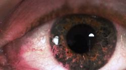 Objawy nowotworu oka. Mogą być mylące (WIDEO)