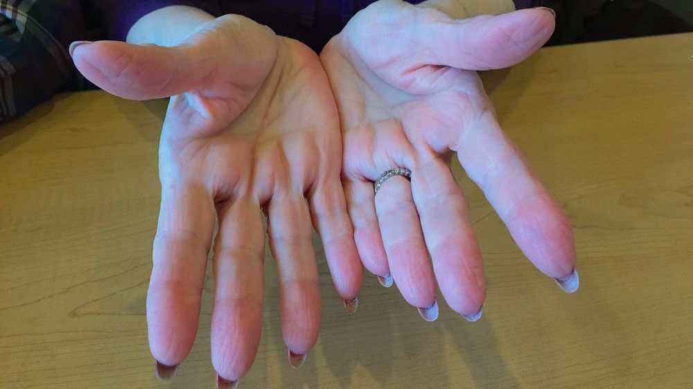 Każdego roku zabija 20 tys. chorych. 87 proc. osób słyszy diagnozę, gdy na wyleczenie jest za późno