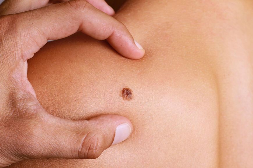 Pieprzyk może okazać się niebezpiecznym rakiem skóry