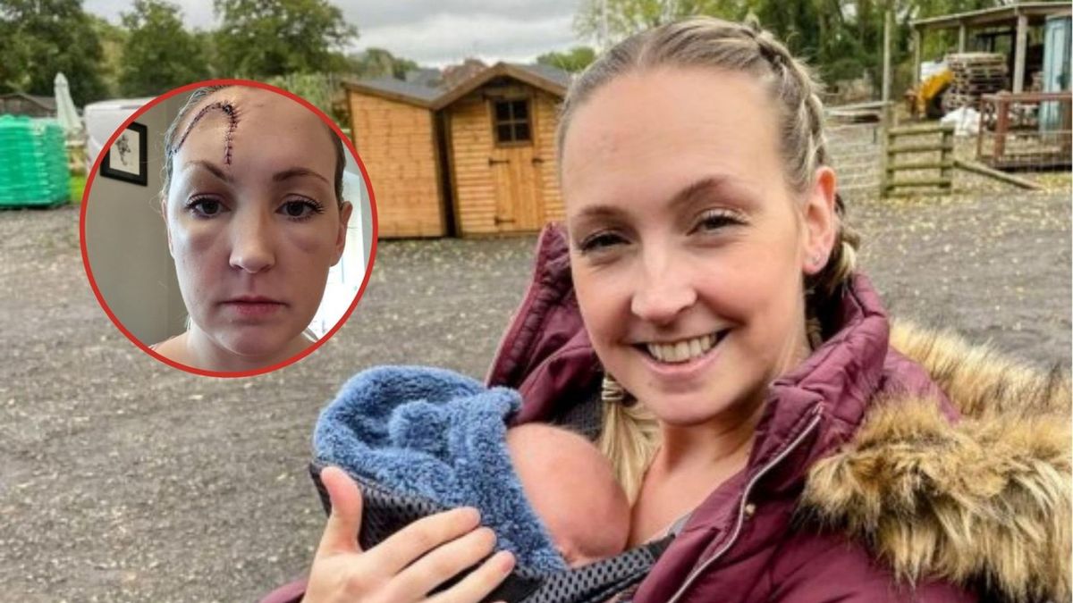 Znamię na czole okazało się nowotworem. "Odcinają skórę i zabierają ją na kilka godzin, aby zbadać ją"