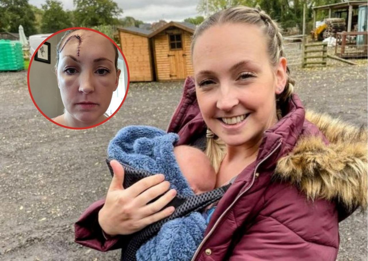 Znamię na czole okazało się nowotworem. Młoda mama przez lata bagatelizowała objawy czerniaka