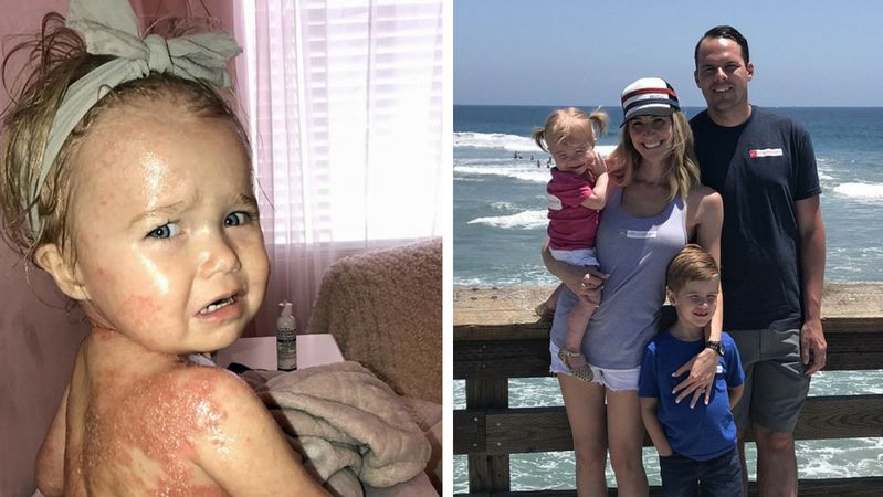 Charlie jest najmłodszą osobą, cierpiącą na zaawansowaną postać łuszczycy