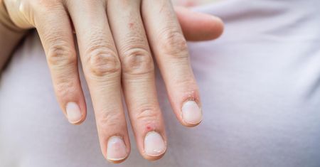 Zmiany na paznokciach, które mogą świadczyć o problemach ze zdrowiem. Nie ignoruj