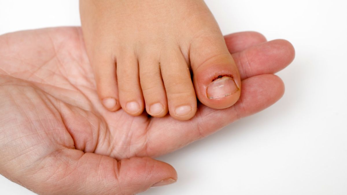 Zanokcica to nic innego jak zapalenie wału paznokciowego.