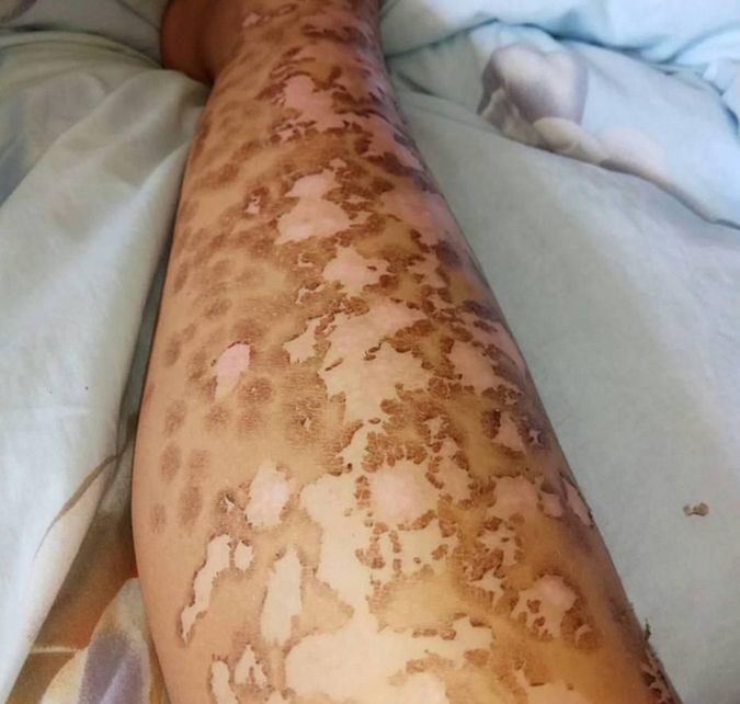 U dziewczyny zdiagnozowano poparzenia pierwszego i drugiego stopnia