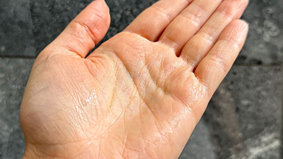 Nadpotliwość dłoni to nie tylko kwestia estetyki, ale realny problem zdrowotny