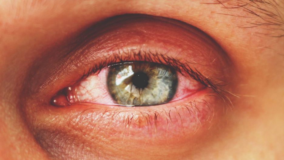 Naświetlone oczy to skutek działania szkodliwego promieniowania. Narażne są na to osoby korzystające z lamp kwarcowych, a także te przebywające w wysokich górach.